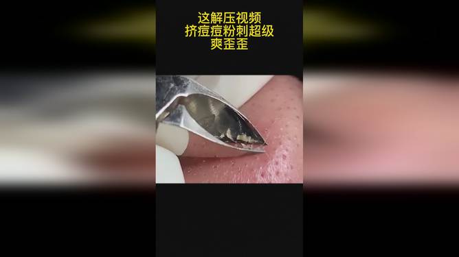 最新擠膿包視頻，見證變化的力量，自信與成就感的誕生之地